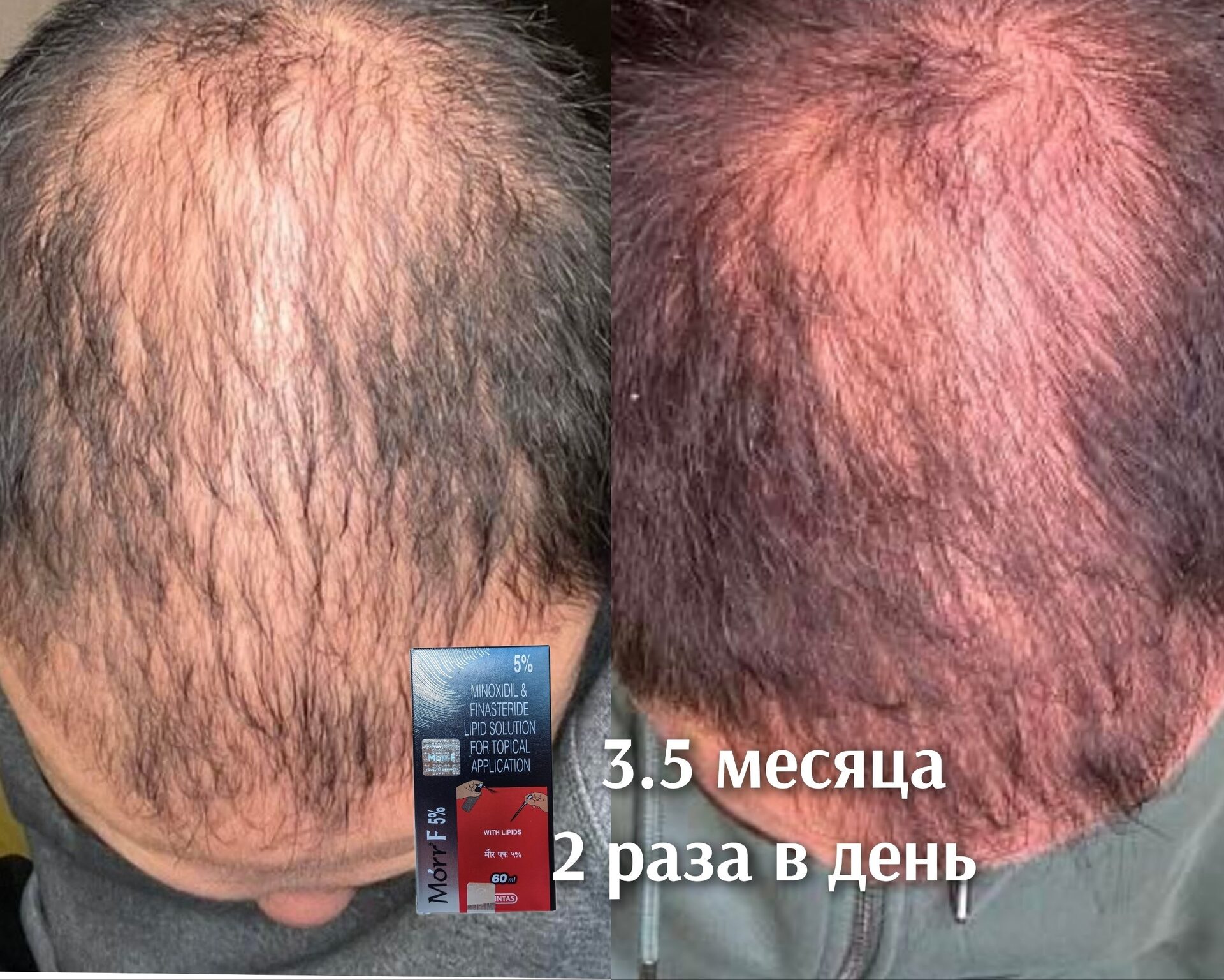Результат Результаты восстановления в 37 лет