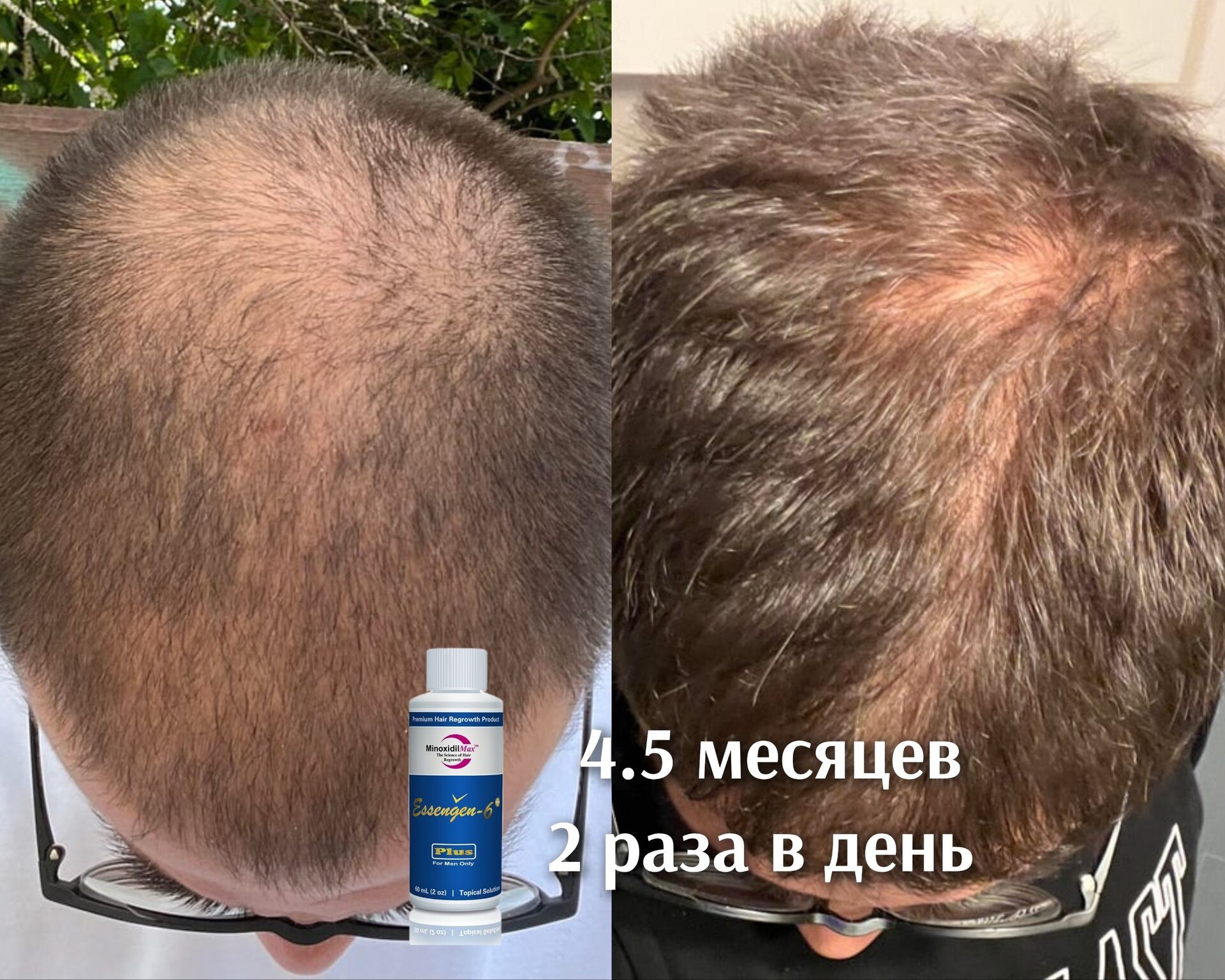Результат Восстановление волос в 43 года