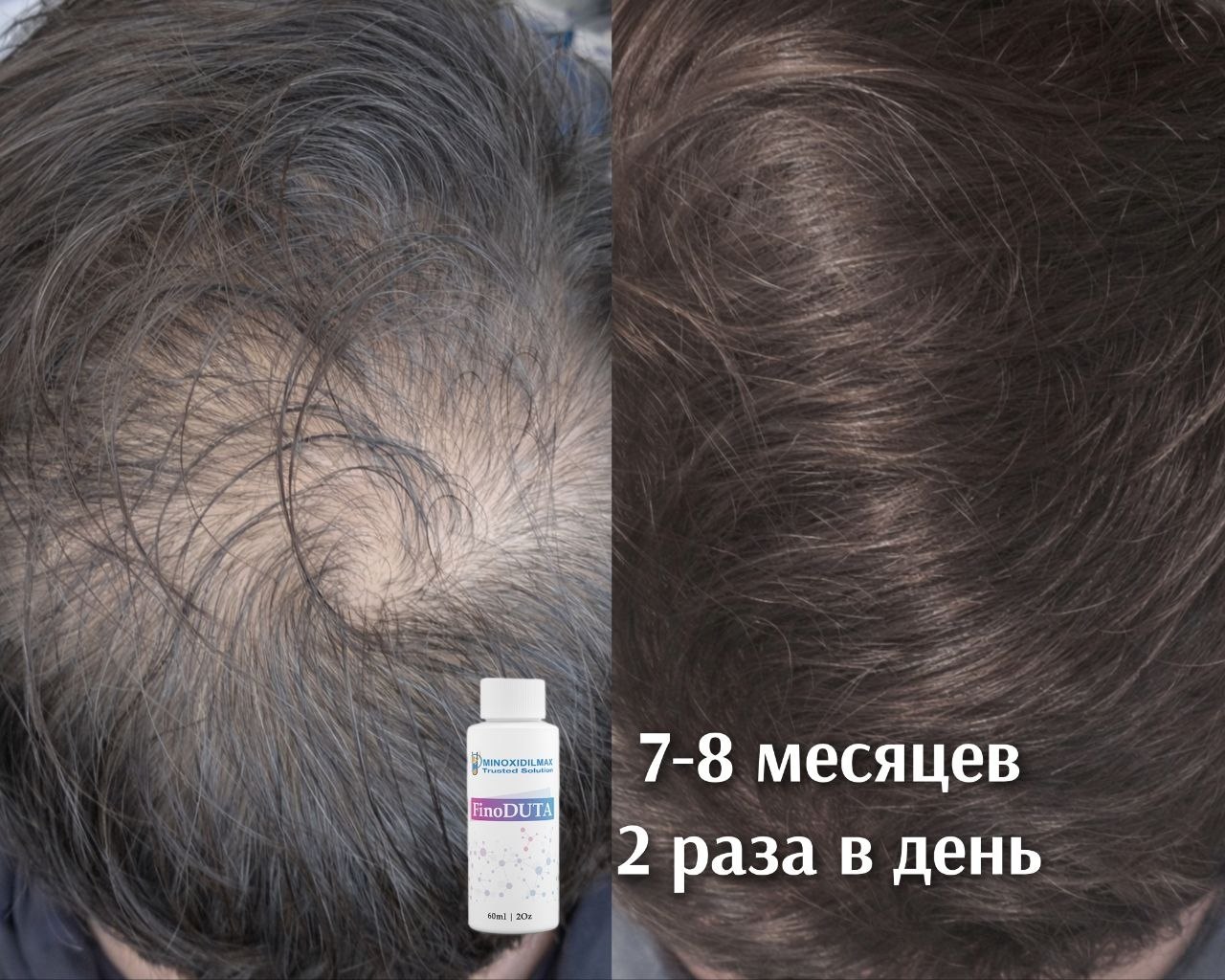 Результат До/после лосьон Финодута