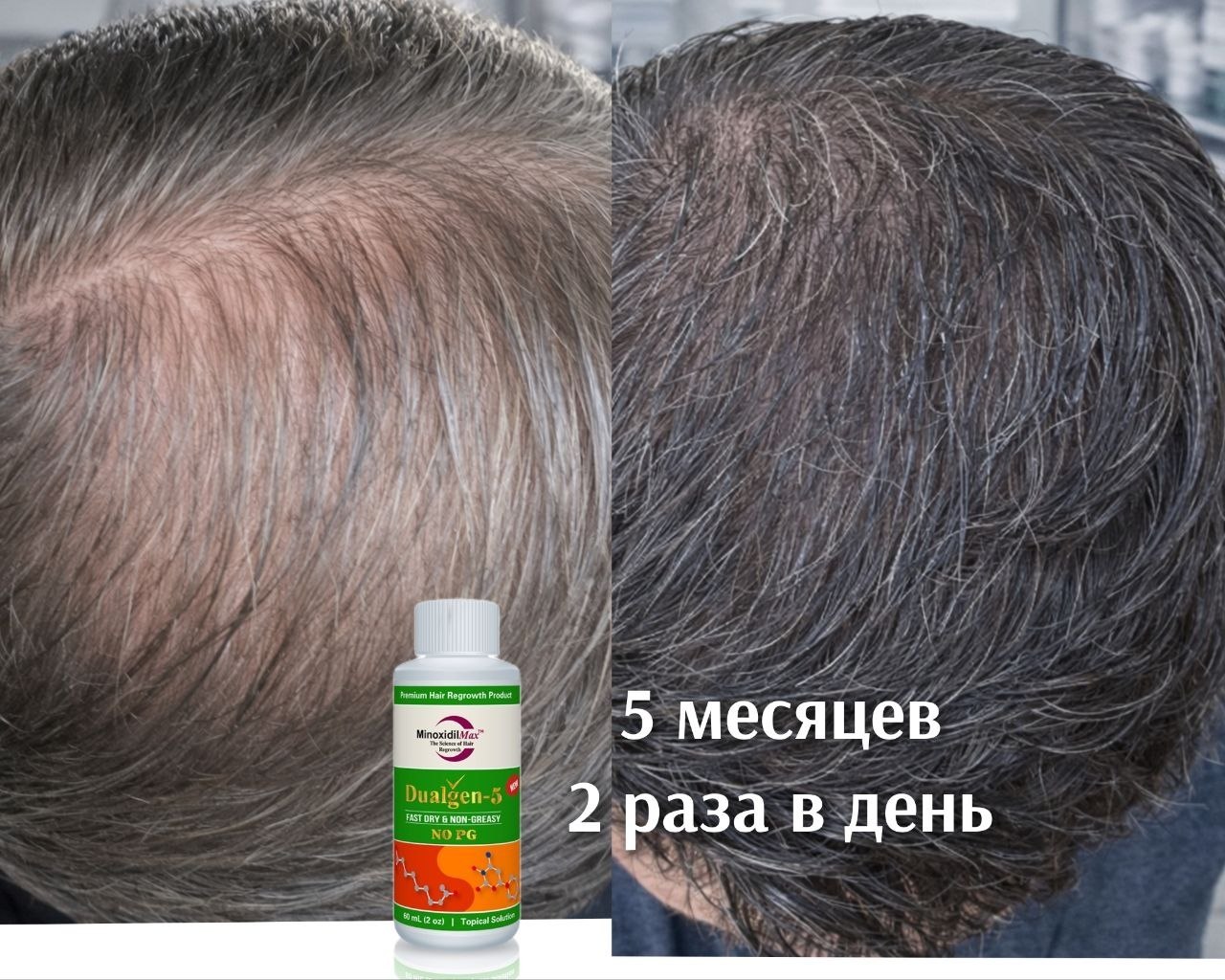 Результат Применение Dualgen 5 месяцев