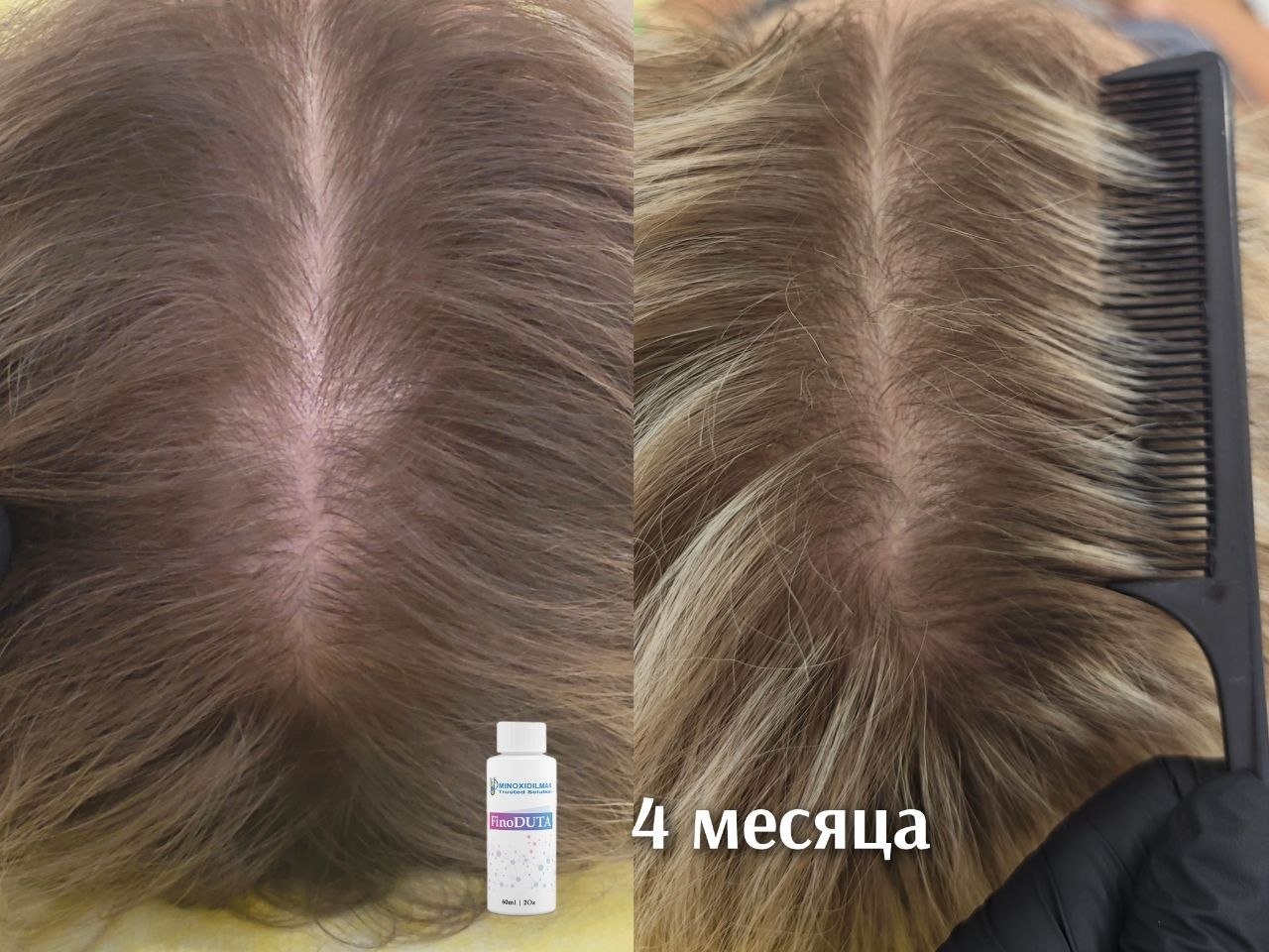 Результат Результат миноксидила после 50 лет