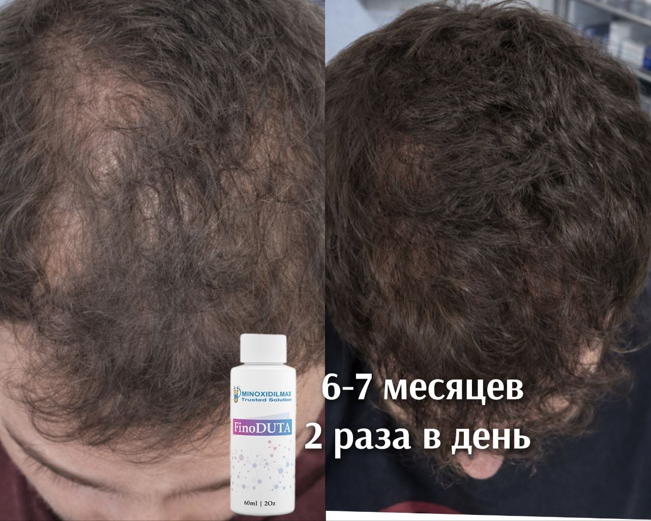 Результат Восстановление густоты волос за полгода