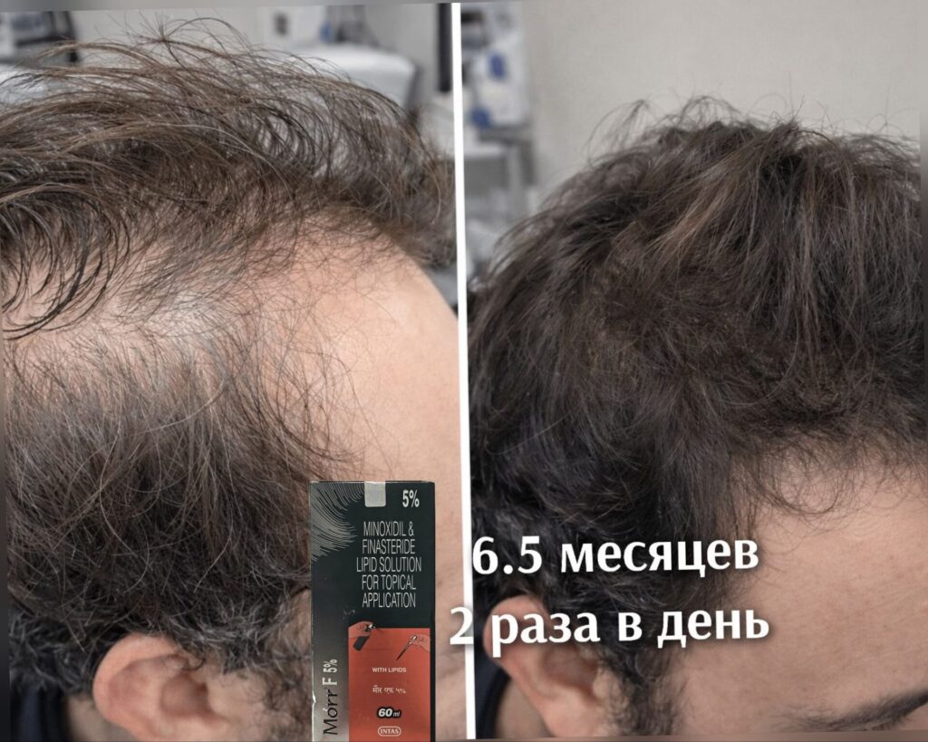 мор ф 5% лосьон