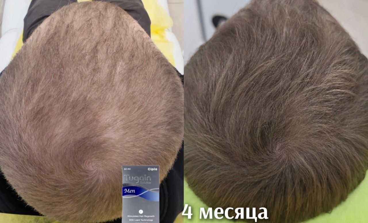 Результат 100% восстановления волос лосьоном Tugain