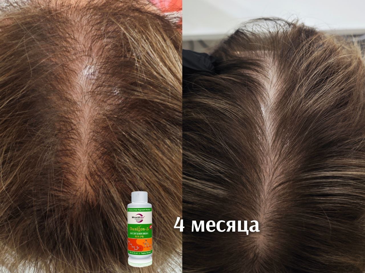 Результат Работа Dualgen fast dry при чувствительной коже головы