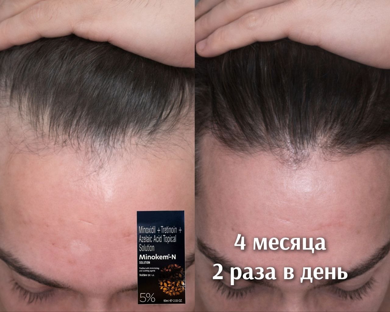 Результат Курс 4 месяца с миноксидилом