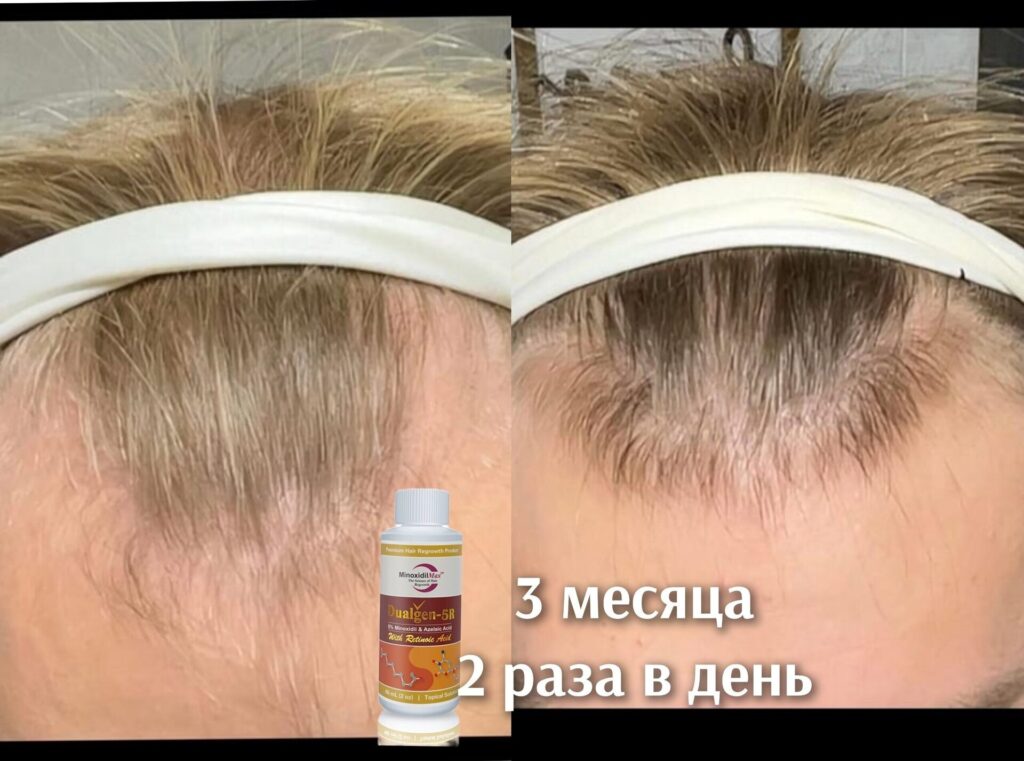 фото до после использования лосьона для роста волос
